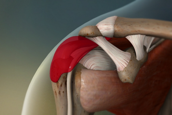 Bursitis